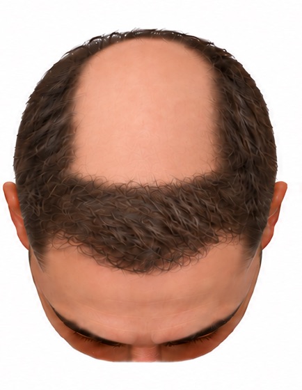 The same scalp restored with roughly 2,000 grafts: the hairline and the whole front third covered, with the mid scalp and crown still bare.