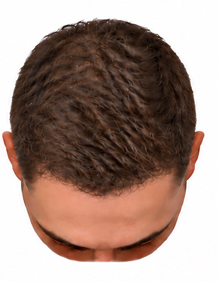 The same scalp restored with roughly 4,000 or more grafts: coverage across the whole top of the head including the crown.