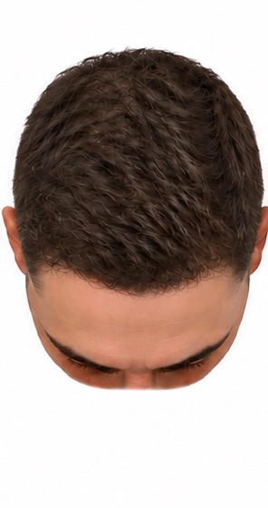 Illustration of stage 1 of the Norwood scale of male pattern hair loss, seen from above: no recession.