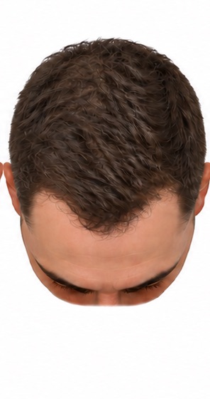 Illustration of stage 2 of the Norwood scale of male pattern hair loss, seen from above: temples recede.