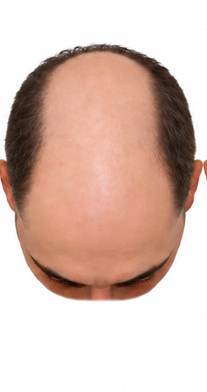 Illustration of stage 6 of the Norwood scale of male pattern hair loss, seen from above: bridge gone.
