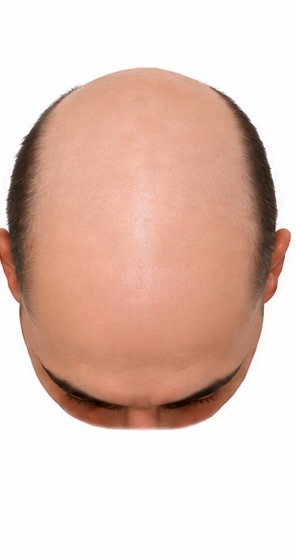 Illustration of stage 7 of the Norwood scale of male pattern hair loss, seen from above: side band only.