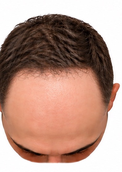 The same scalp at one month. The transplanted hairs have shed and the front third is bare again, while the permanent hair at the back, sides and crown has grown back out of the shave and is dense and normal.