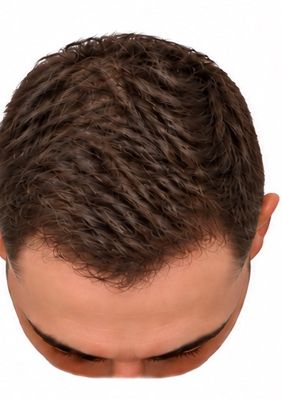 The same scalp at twelve months. The front third is densely covered and blends with the surrounding hair, with a natural irregular hairline.
