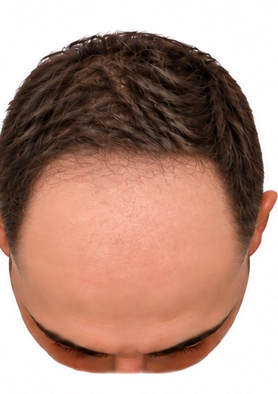 The same scalp at three months. The front third still looks bare, with only the faintest fine hair starting. The American Academy of Dermatology notes the hair may look thinner at this stage than it did before the transplant.