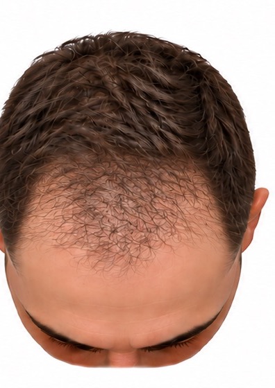 The same scalp at six months. New hair covers the front third and the hairline shape is readable, though it is still thinner than the hair behind it.