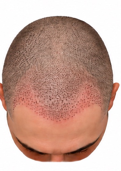 Illustration of a shaved scalp one week after a hair transplant, showing the implanted grafts as thousands of tiny dark dots with pinpoint scabs and pink redness across the front third.